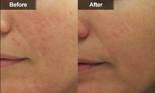 Blood Vessels Removal Diode Laser 980nm Diode Laser Varicose Veins Removal