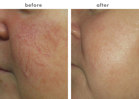 Blood Vessels Removal Diode Laser 980nm Diode Laser Varicose Veins Removal