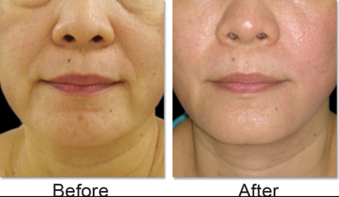 Hifu high intensity focused ultrasound for face lifting with vertical stand