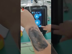 P9 Nd Yag Laser Picosecond Laser Tattoo Removal Device