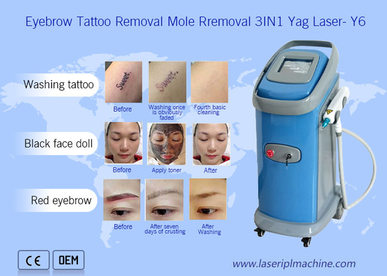 1064nm 532nm Nd Yag Laser Tattoo Removal Machine Dermatology
